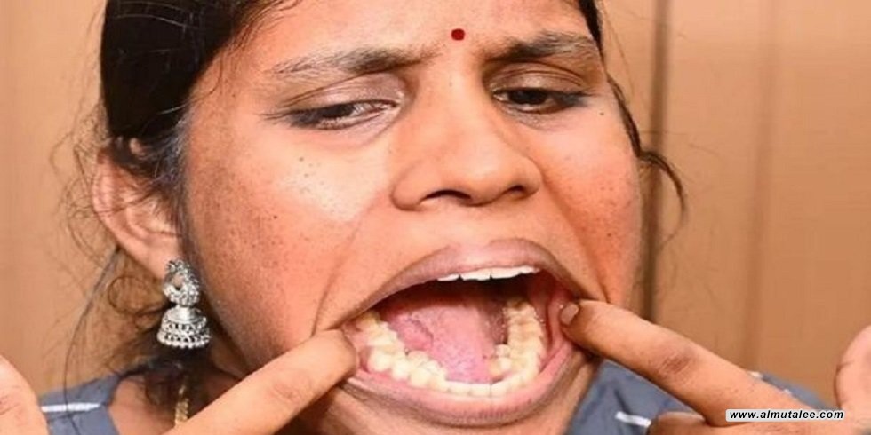 تملك "38" سناً... امرأة هندية تدخل موسوعة غينيس بعدد الأسنان